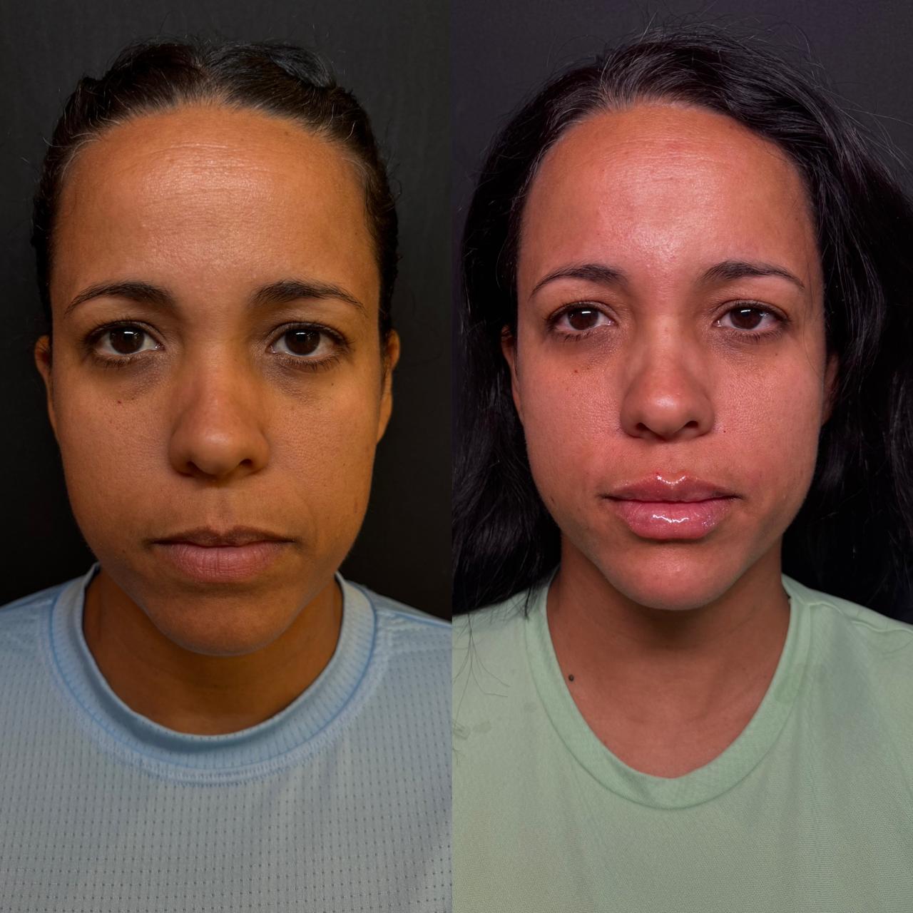 Antes e depois de harmonização Full Face