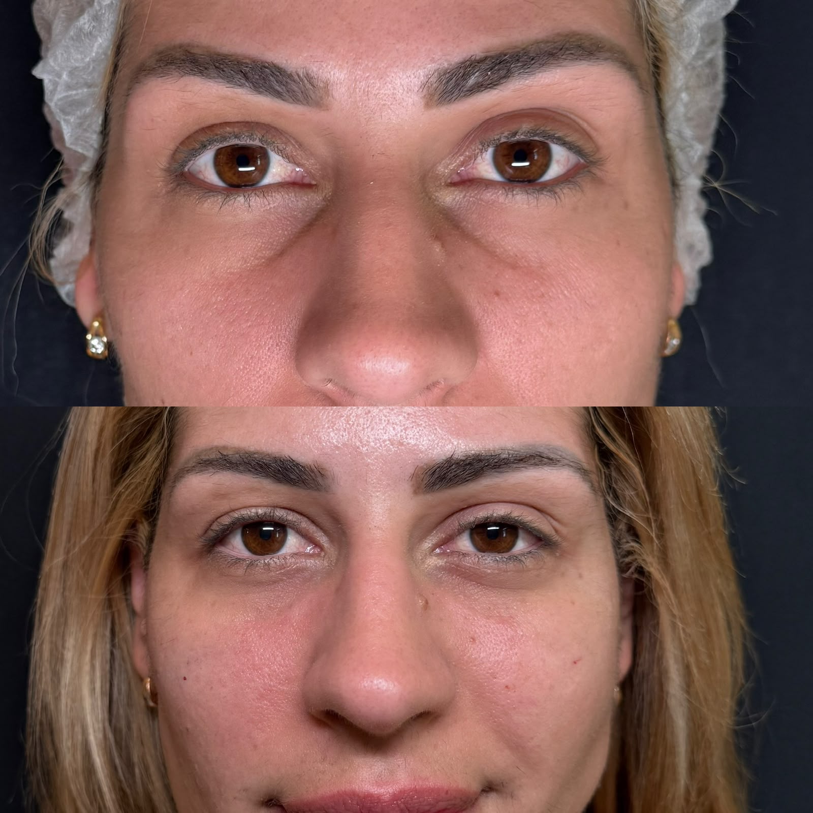 Caso clínico de harmonização facial