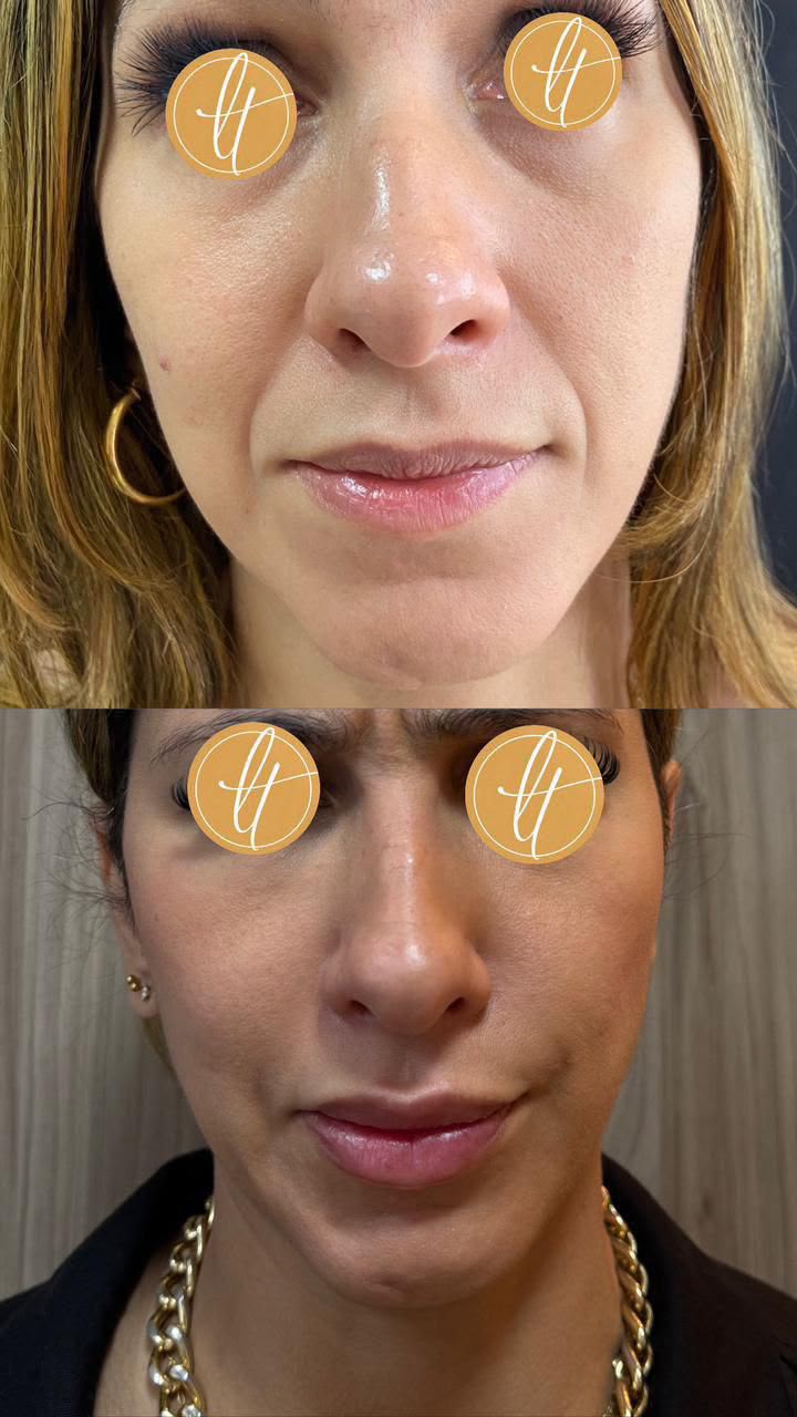 Caso clínico de harmonização facial