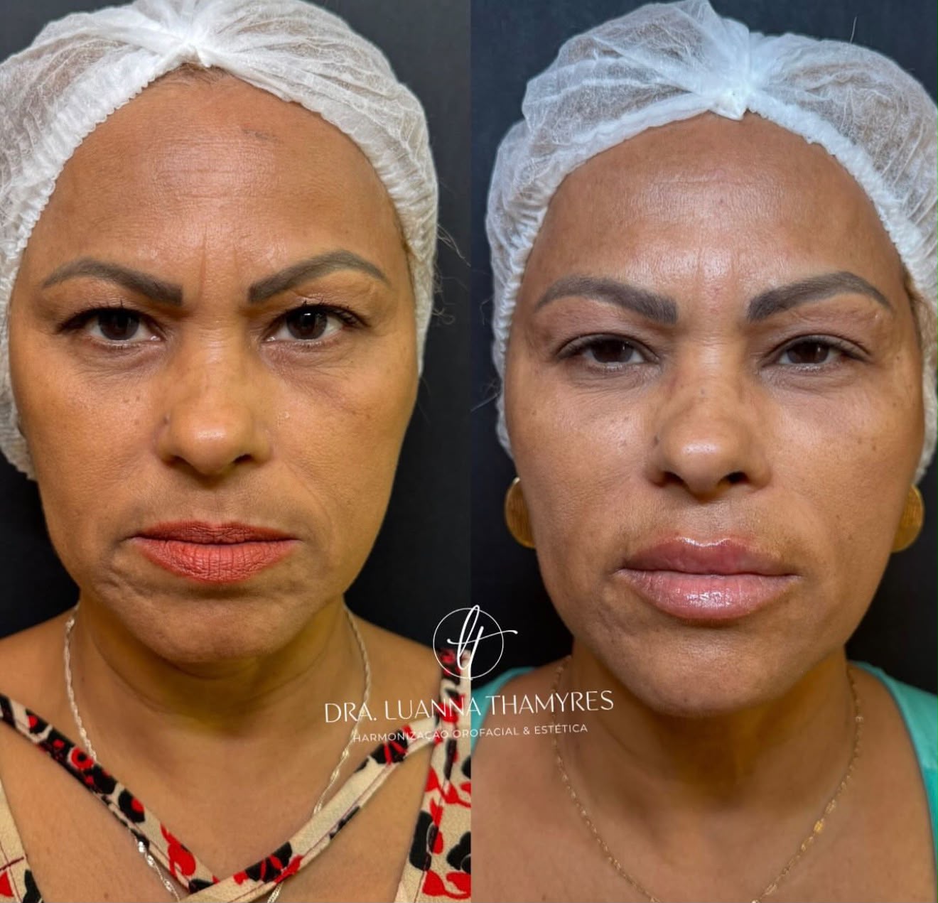Caso clínico de harmonização facial