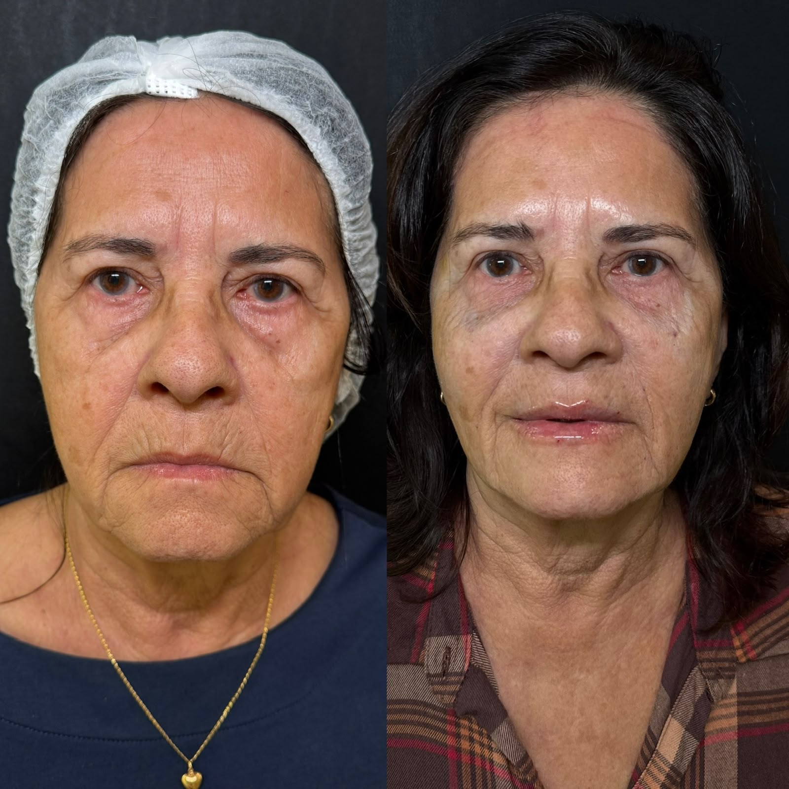Caso clínico de harmonização facial